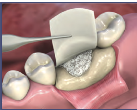 MatrixDerm Porcine Collagen Membrane