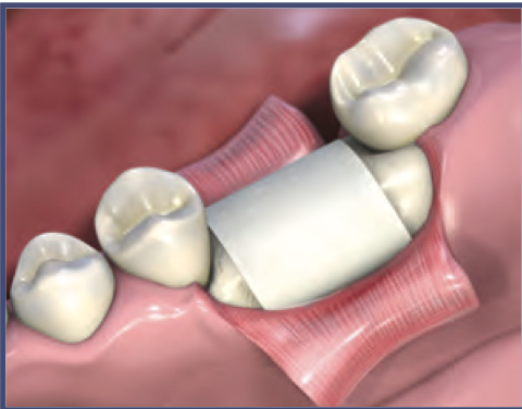 MatrixDerm Porcine Collagen Membrane