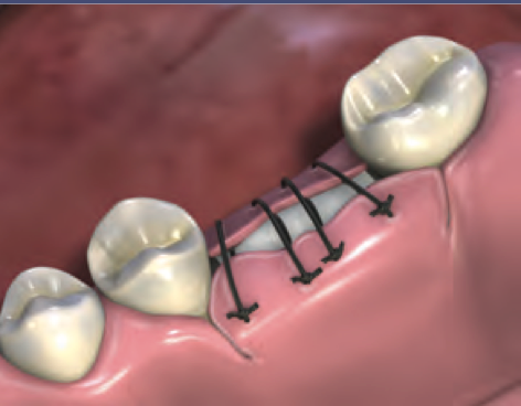 MatrixDerm Porcine Collagen Membrane