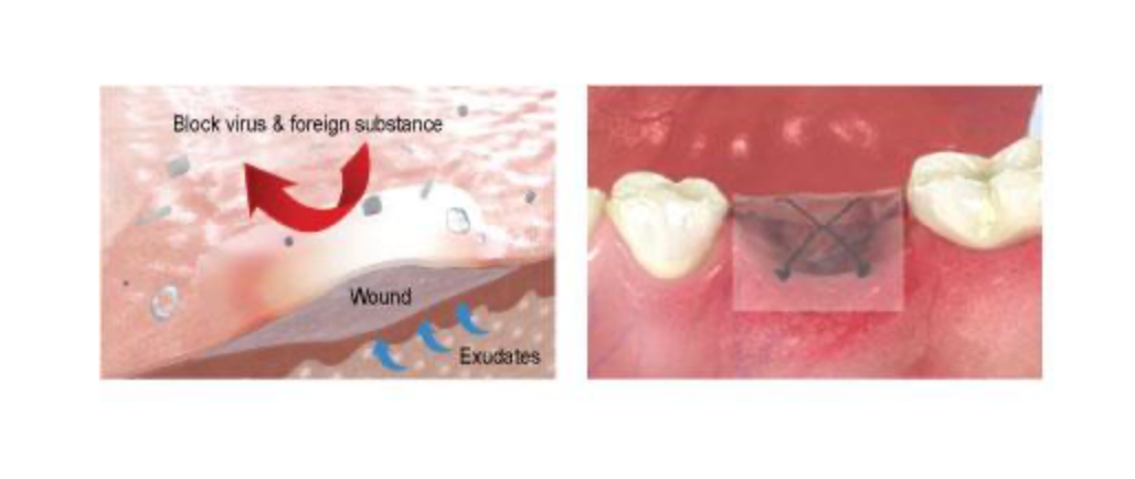 Ora-Aid Intraoral Wound Dressing