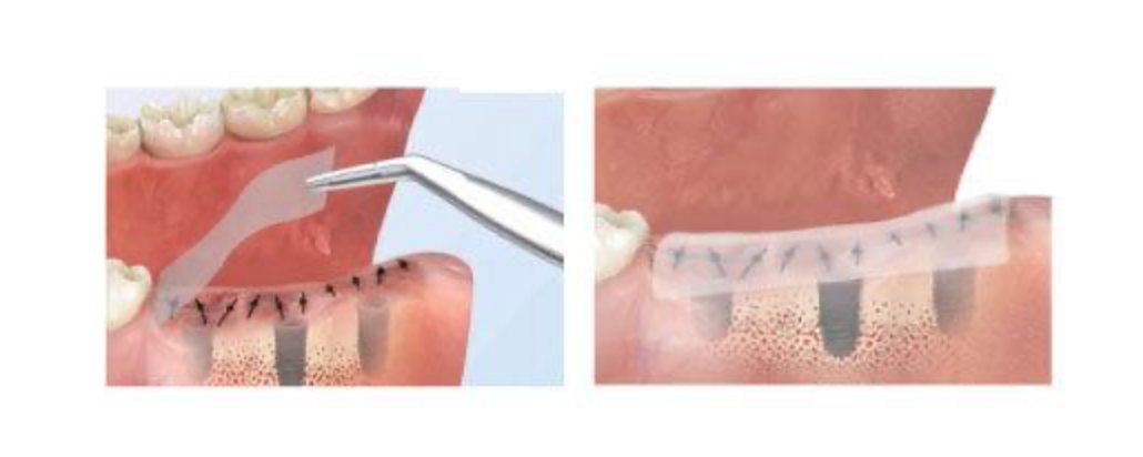 Ora-Aid Intraoral Wound Dressing