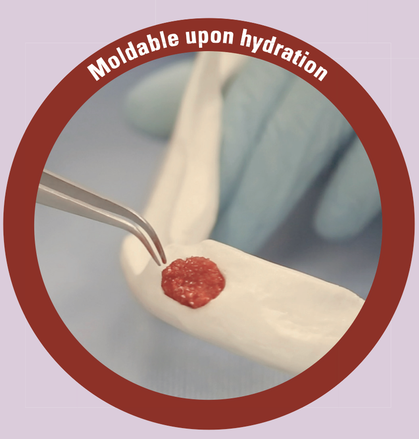 SynOss Synthetic/Collagen Putty