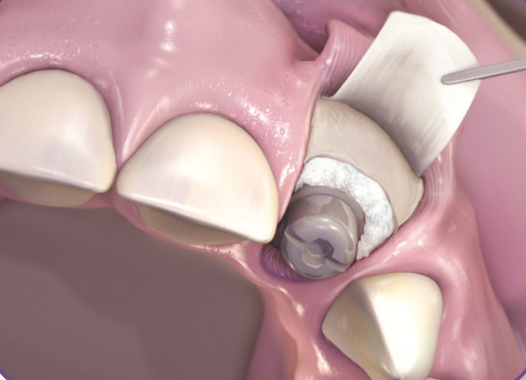 SynOss Synthetic/Collagen Putty