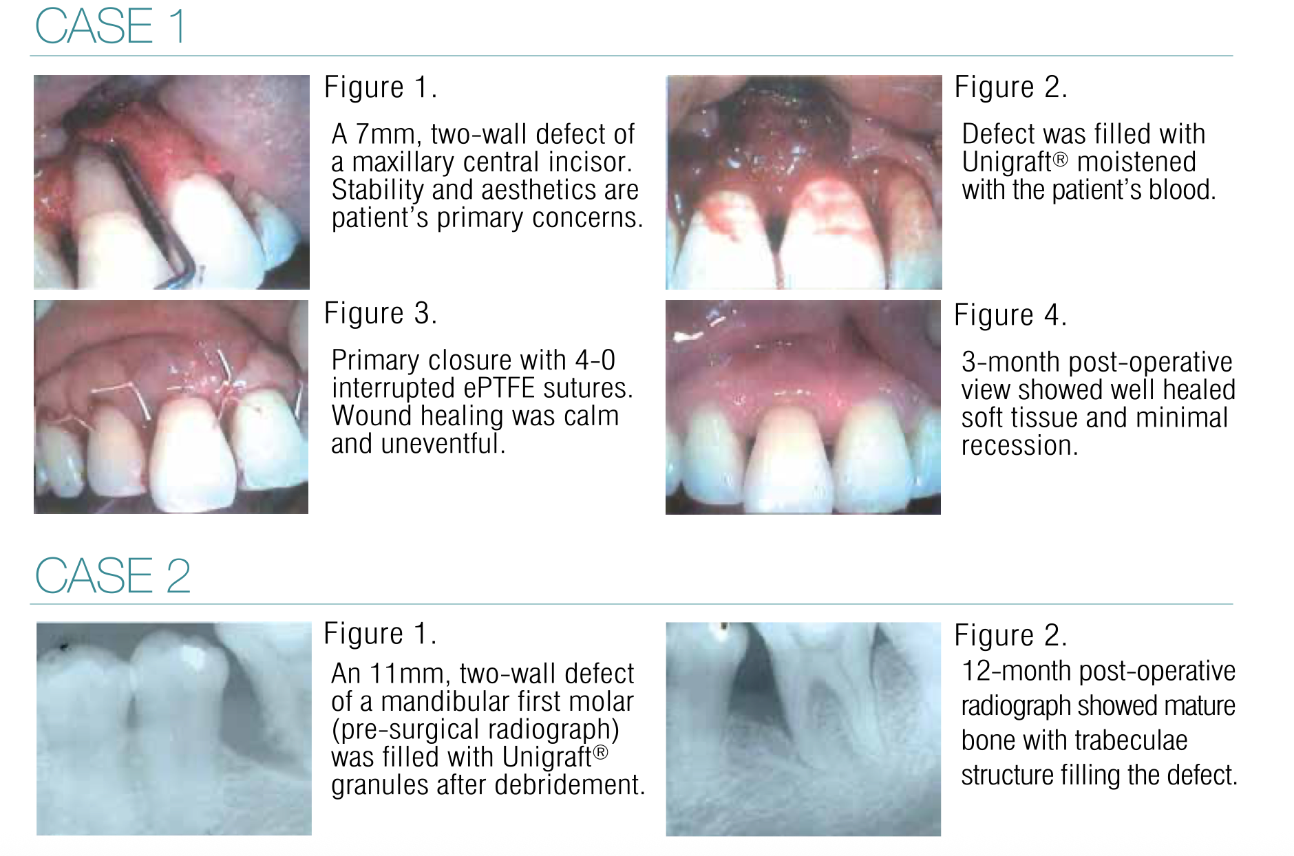 UNIGRAFT® Synethic Bone Particulate