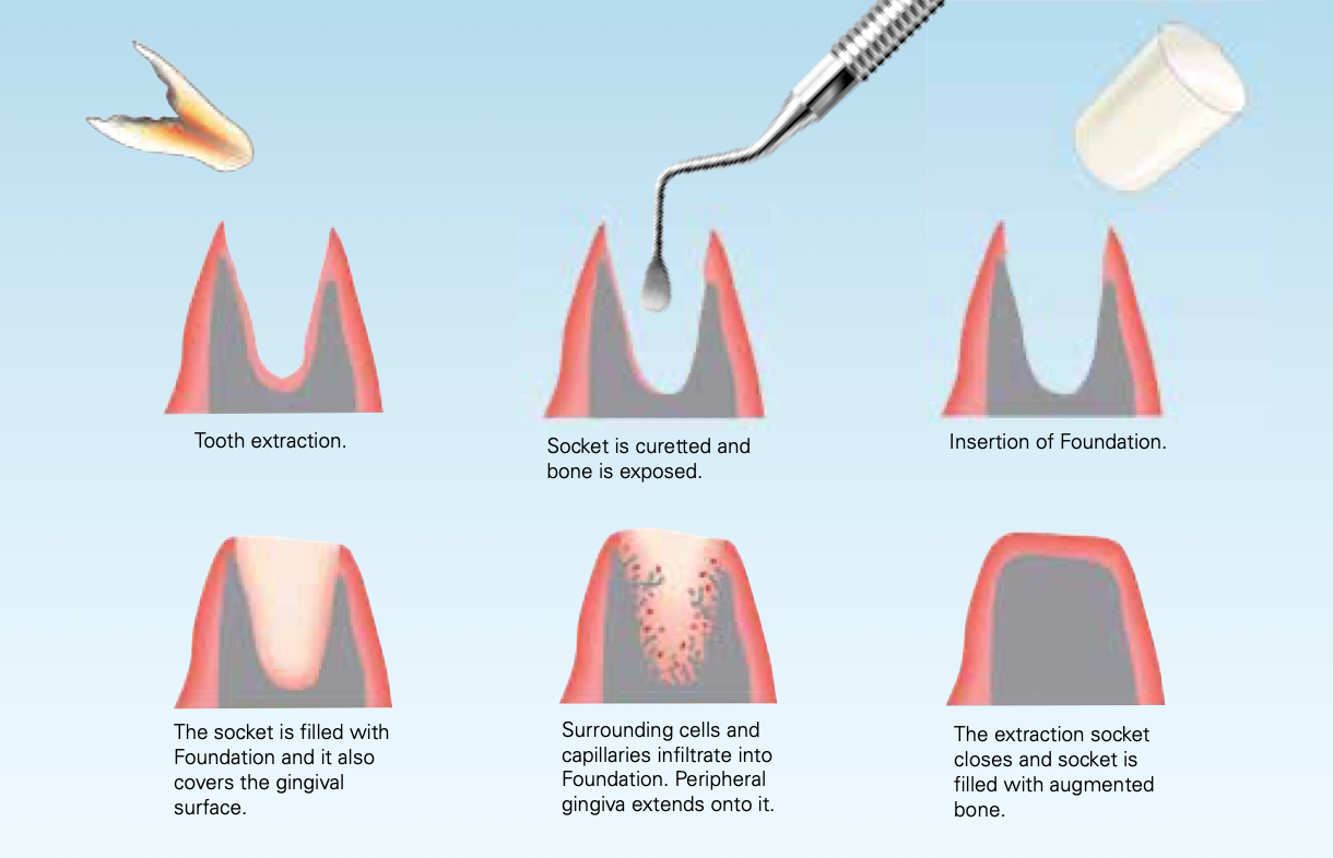 Foundation Bone Filling Augmentation Material